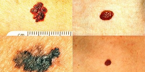 Tassi di sopravvivenza ai 5 anni per pazienti affetti da melanoma trattati con la terapia Gerson