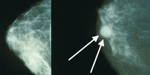 Tumore al seno. Aggiornamenti dal Gerson Institute