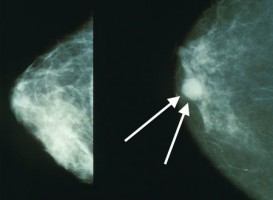 Tumore al seno. Aggiornamenti dal Gerson Institute